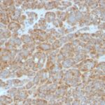 FFPE human melanoma sections stained with 100 ul anti-Bcl-2 (clone BCL2/796) at 1:300. HIER epitope retrieval prior to staining was performed in 10mM Tris 1mM EDTA, pH 9.0.